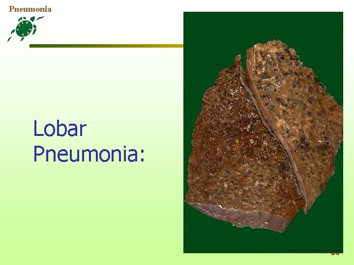 Pneumonia Lobar Pneumonia: 20 