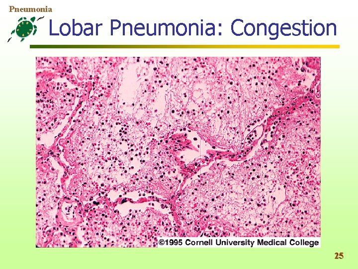 Pneumonia Lobar Pneumonia: Congestion 25 