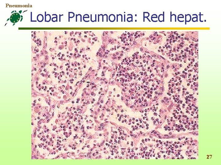 Pneumonia Lobar Pneumonia: Red hepat. 27 