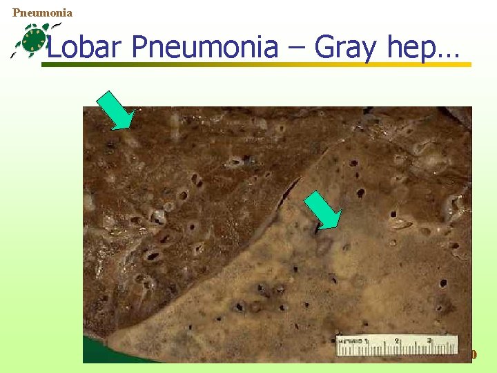Pneumonia Lobar Pneumonia – Gray hep… 30 