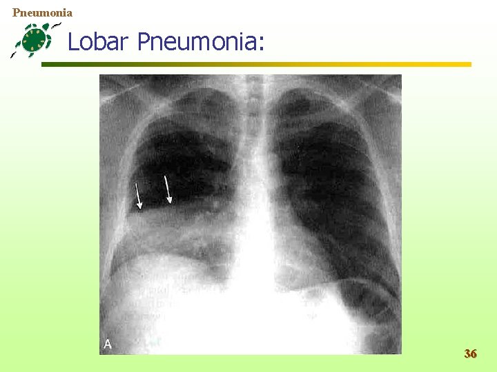 Pneumonia Lobar Pneumonia: 36 