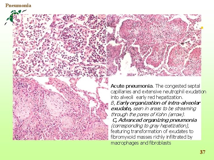 Pneumonia Acute pneumonia. The congested septal capillaries and extensive neutrophil exudation into alveoli early