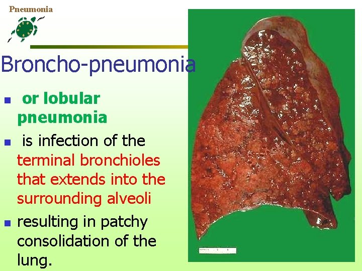 Pneumonia Broncho-pneumonia n n n or lobular pneumonia is infection of the terminal bronchioles