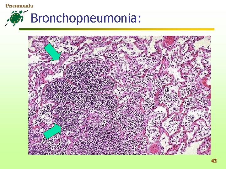 Pneumonia Bronchopneumonia: 42 