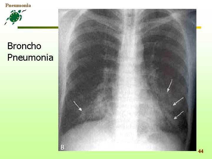 Pneumonia Broncho Pneumonia 44 