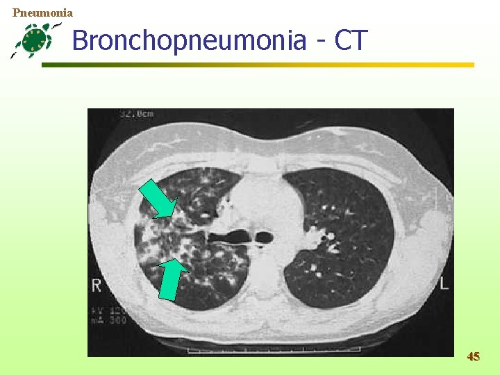 Pneumonia Bronchopneumonia - CT 45 