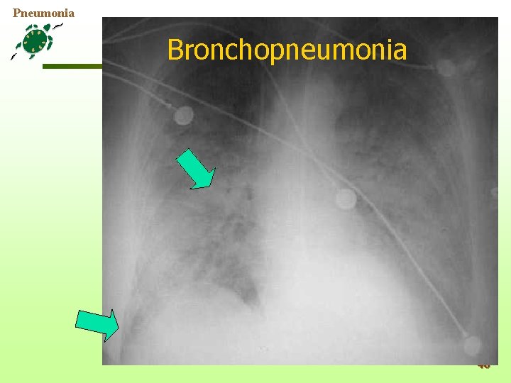 Pneumonia Bronchopneumonia 46 