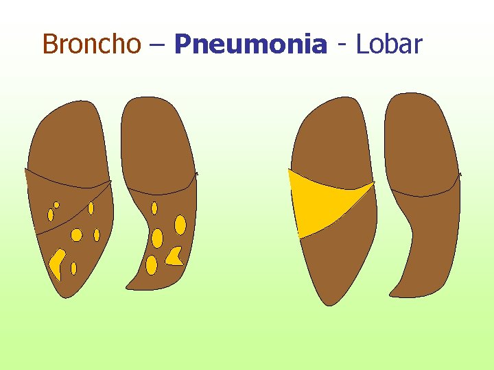 Broncho – Pneumonia - Lobar 