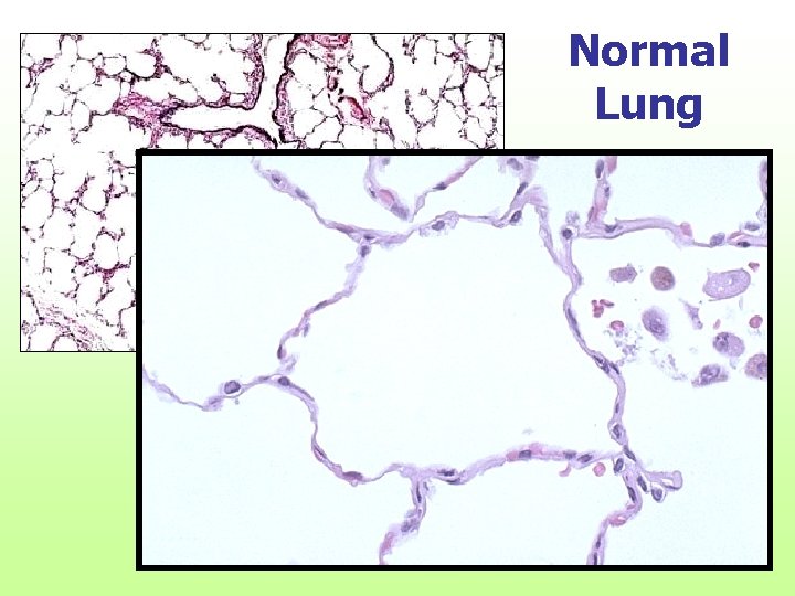 Normal Lung 