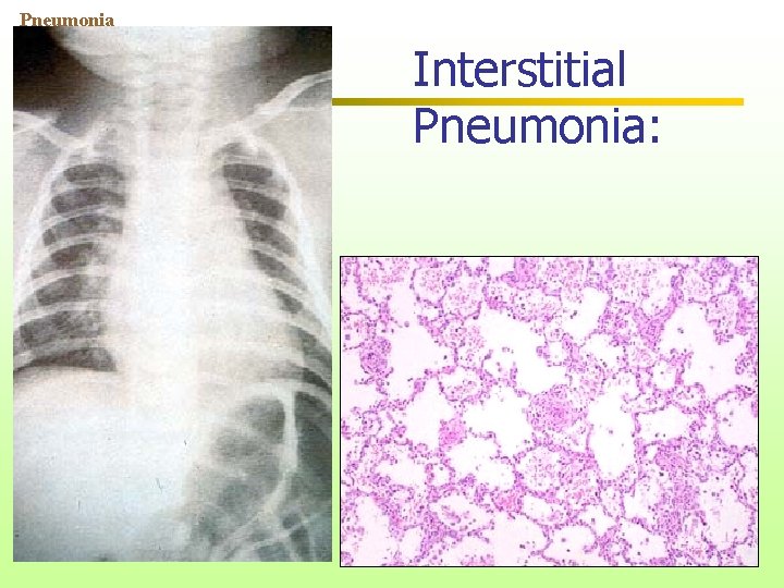 Pneumonia Interstitial Pneumonia: 55 