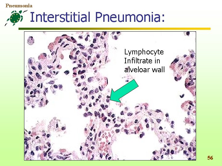 Pneumonia Interstitial Pneumonia: Lymphocyte Infiltrate in alveloar wall 56 