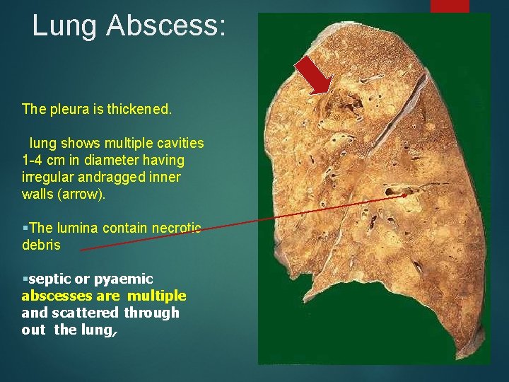 Lung Abscess: The pleura is thickened. lung shows multiple cavities 1 -4 cm in