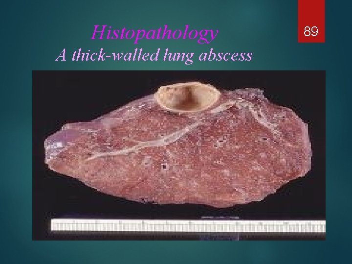 Histopathology A thick-walled lung abscess 89 