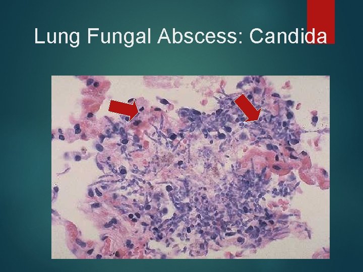 Lung Fungal Abscess: Candida 