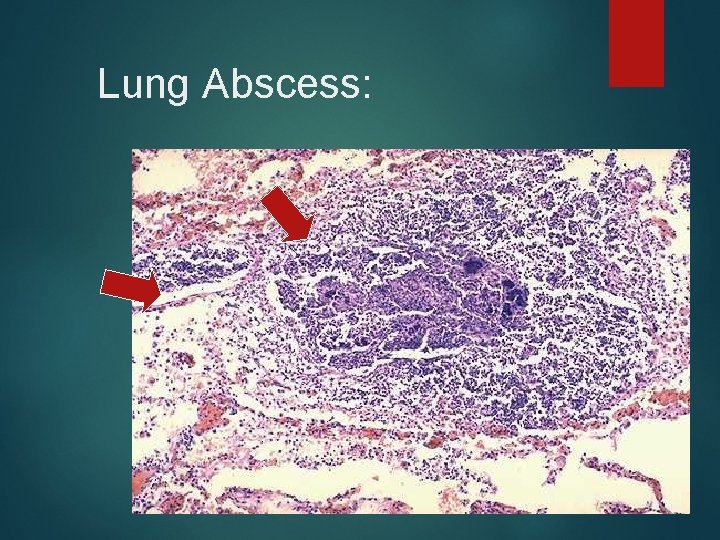 Lung Abscess: 
