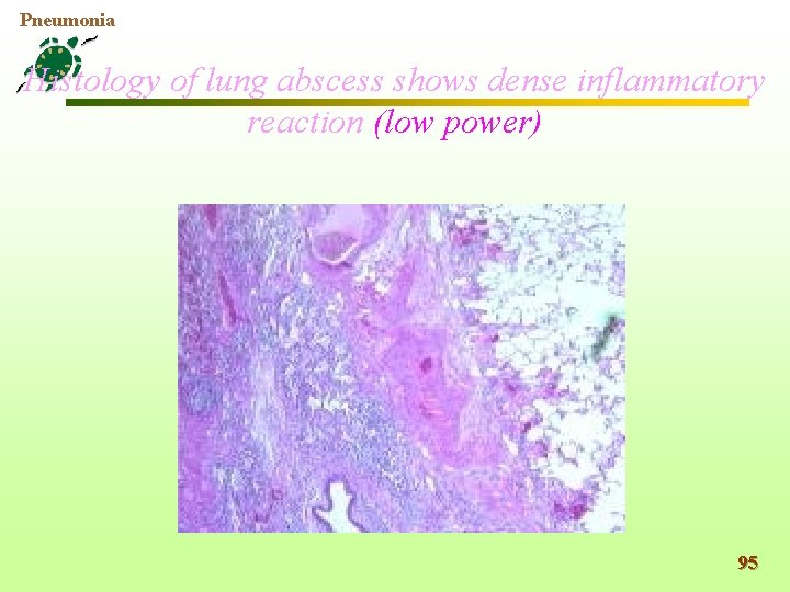 Pneumonia Histology of lung abscess shows dense inflammatory reaction (low power) 95 