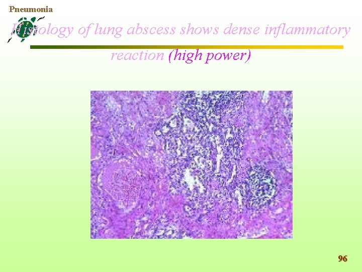 Pneumonia Histology of lung abscess shows dense inflammatory reaction (high power) 96 