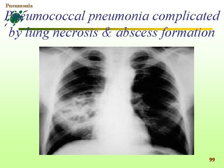 Pneumonia Pneumococcal pneumonia complicated by lung necrosis & abscess formation 99 