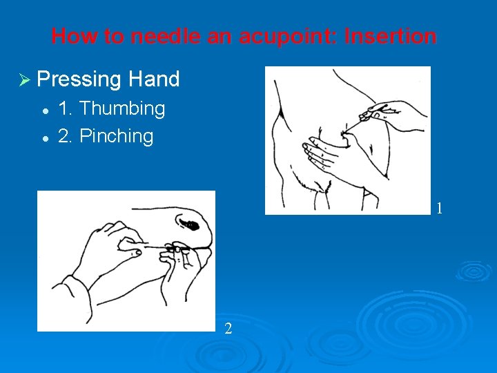 How to needle an acupoint: Insertion Ø Pressing Hand l l 1. Thumbing 2.