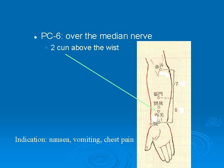 l PC-6: over the median nerve • 2 cun above the wist Indication: nausea,