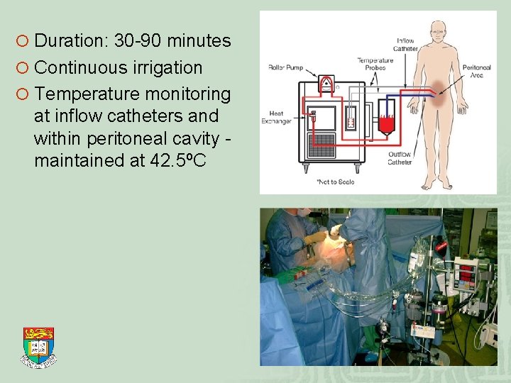 ¡ Duration: 30 -90 minutes ¡ Continuous irrigation ¡ Temperature monitoring at inflow catheters