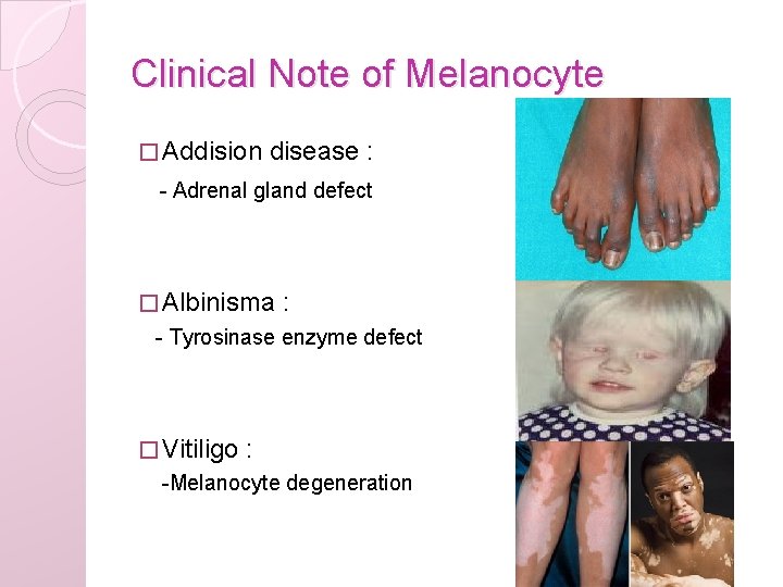 Clinical Note of Melanocyte � Addision disease : - Adrenal gland defect � Albinisma
