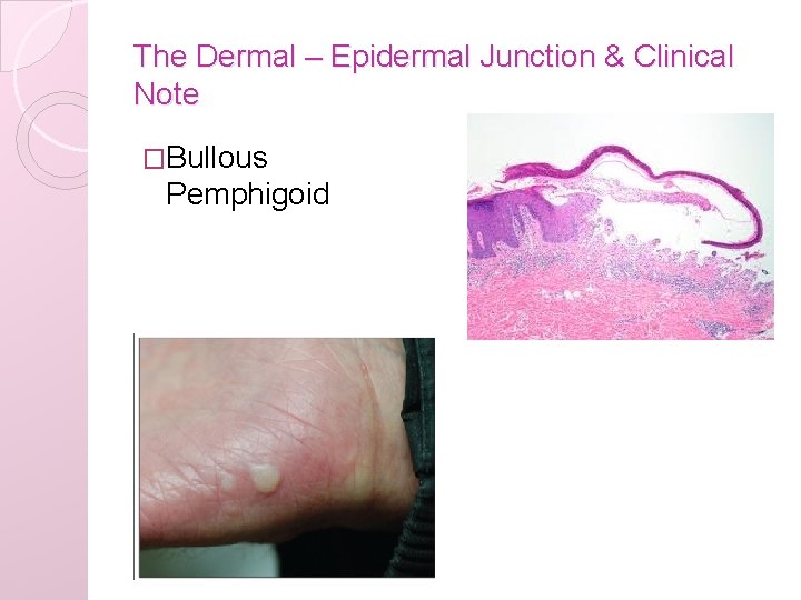 The Dermal – Epidermal Junction & Clinical Note �Bullous Pemphigoid 