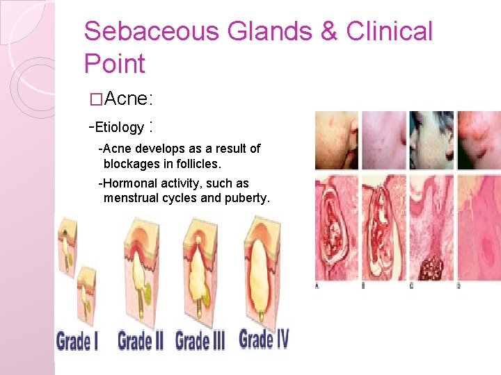 Sebaceous Glands & Clinical Point �Acne: -Etiology : -Acne develops as a result of
