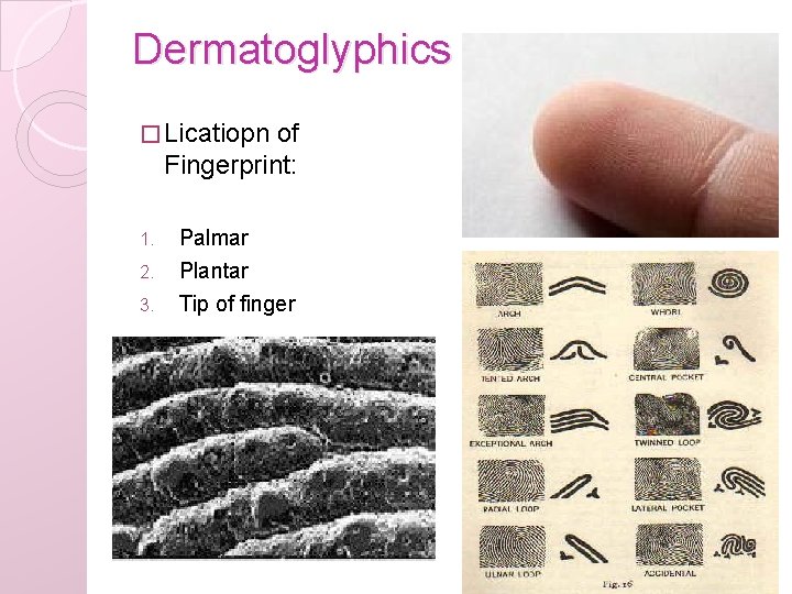 Dermatoglyphics � Licatiopn of Fingerprint: 1. 2. 3. Palmar Plantar Tip of finger 
