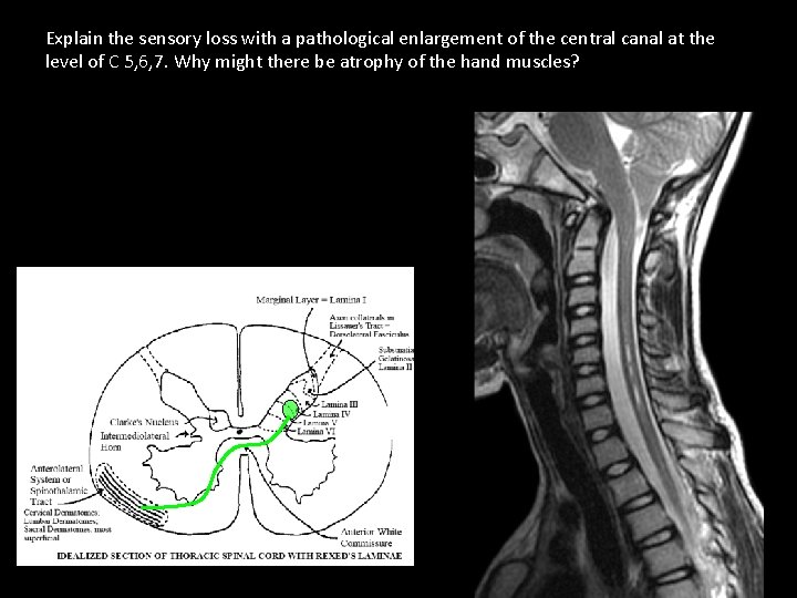 Explain the sensory loss with a pathological enlargement of the central canal at the