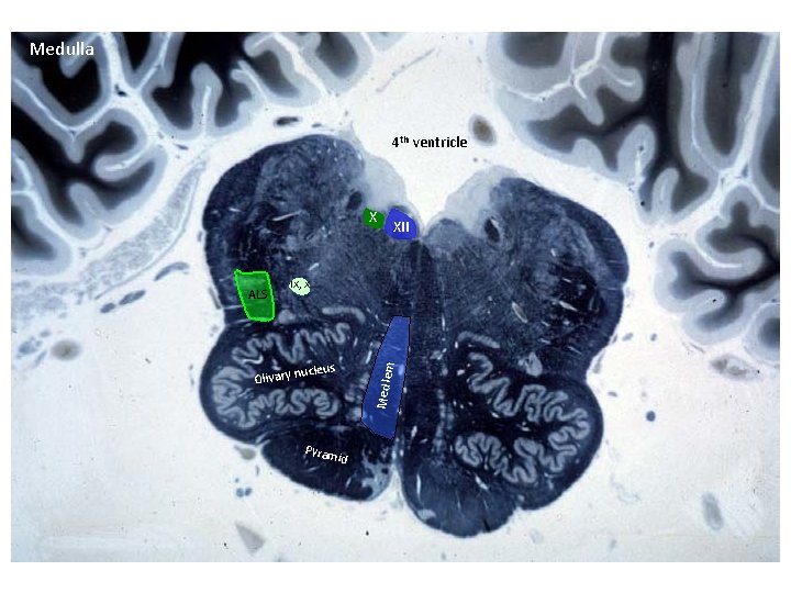 Medulla 4 th ventricle X IX, X Olivary n ucleus Pyram Med lem ALS