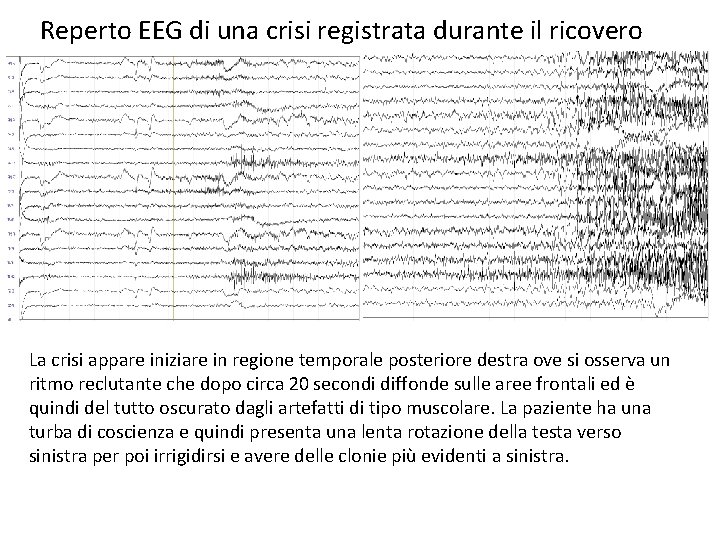 Reperto EEG di una crisi registrata durante il ricovero La crisi appare iniziare in