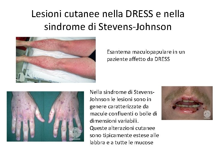 Lesioni cutanee nella DRESS e nella sindrome di Stevens-Johnson Esantema maculopapulare in un paziente