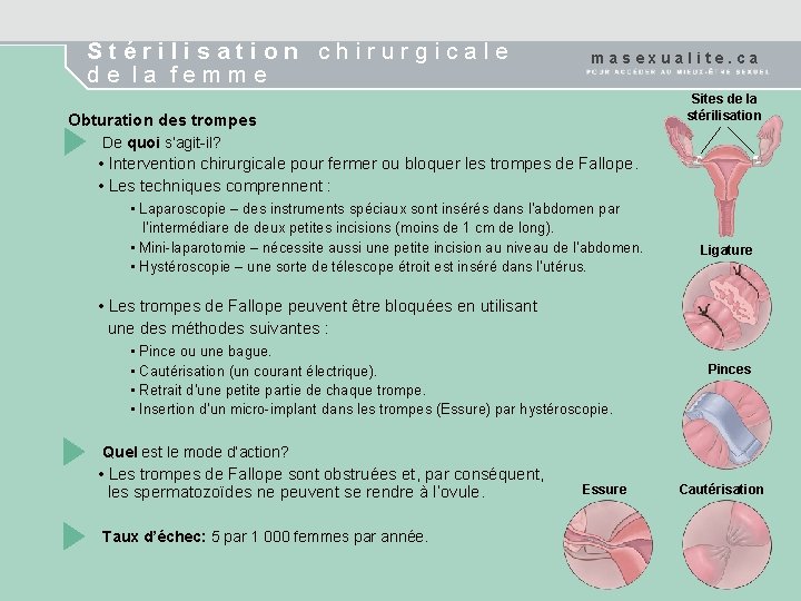 Stérilisation chirurgicale de la femme masexualite. ca Sites de la stérilisation Obturation des trompes