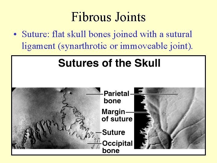 Fibrous Joints • Suture: flat skull bones joined with a sutural ligament (synarthrotic or