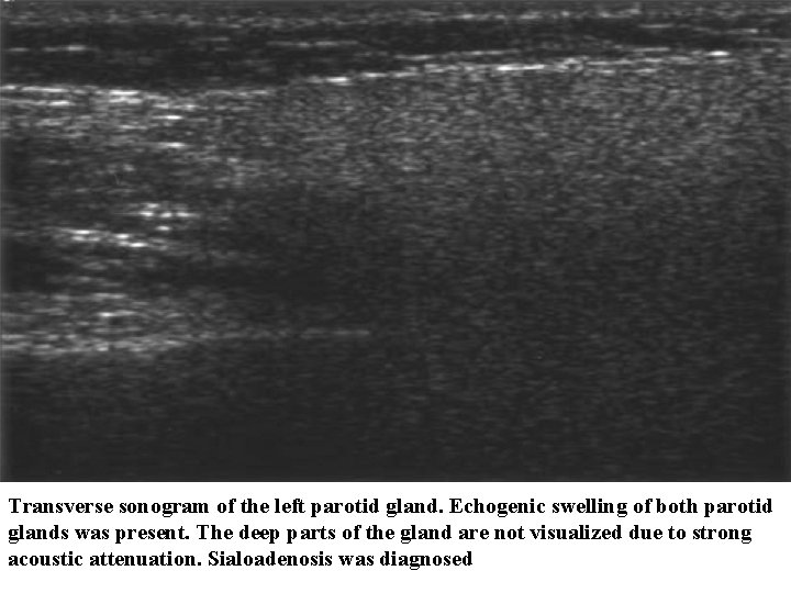 Transverse sonogram of the left parotid gland. Echogenic swelling of both parotid glands was