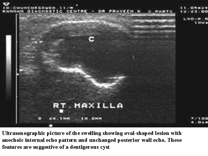 Ultrasonographic picture of the swelling showing oval-shaped lesion with anechoic internal echo pattern and