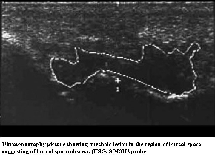 Ultrasonography picture showing anechoic lesion in the region of buccal space suggesting of buccal