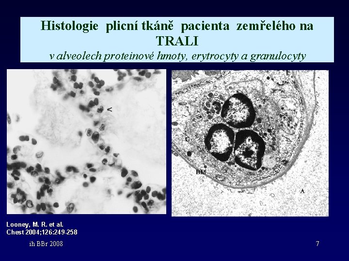 Histologie plicní tkáně pacienta zemřelého na TRALI v alveolech proteinové hmoty, erytrocyty a granulocyty