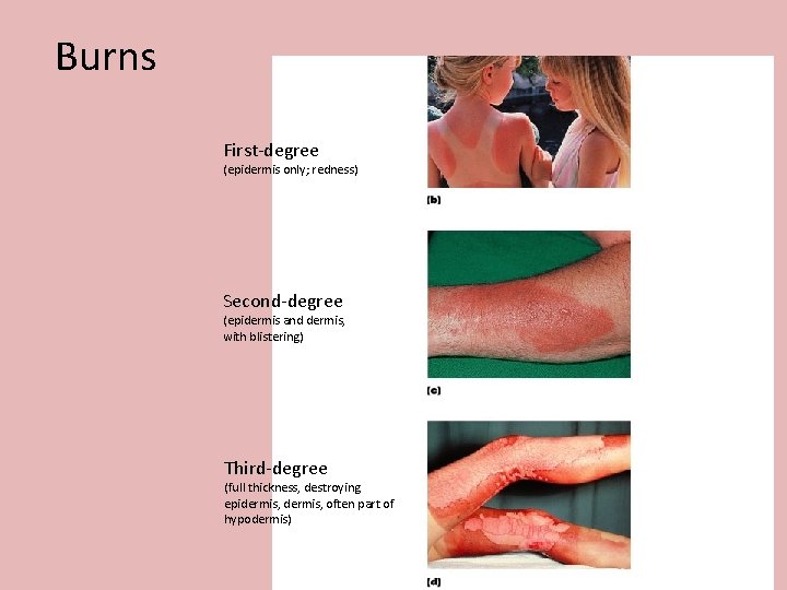 Burns First-degree (epidermis only; redness) Second-degree (epidermis and dermis, with blistering) Third-degree (full thickness, Burns First-degree (epidermis only; redness) Second-degree (epidermis and dermis, with blistering) Third-degree (full thickness,