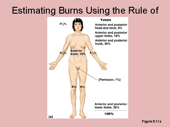 Estimating Burns Using the Rule of Nines Figure 5. 11 a Estimating Burns Using the Rule of Nines Figure 5. 11 a