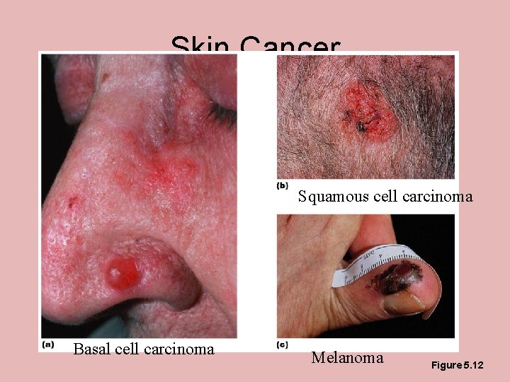 Skin Cancer Squamouscellcarcinoma Basal cell carcinoma Melanoma Figure 5. 12 Skin Cancer Squamouscellcarcinoma Basal cell carcinoma Melanoma Figure 5. 12