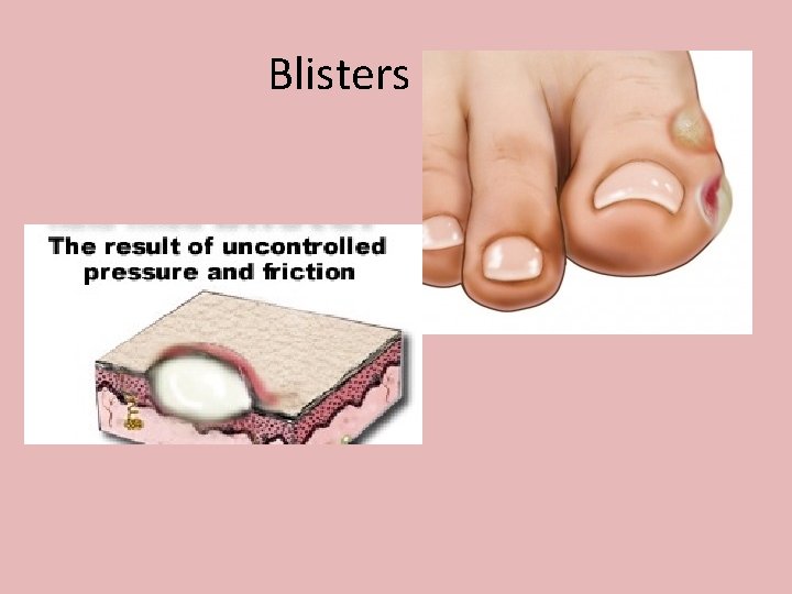 Blisters 