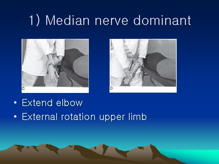 1) Median nerve dominant • Extend elbow • External rotation upper limb 