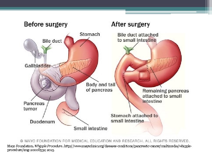 Mayo Foundation. Whipple Procedure. http: //www. mayoclinic. org/diseases-conditions/pancreatic-cancer/multimedia/whippleprocedure/img-20008531; 2015. 