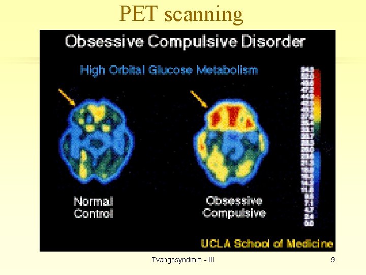 PET scanning Tvangssyndrom - III 9 