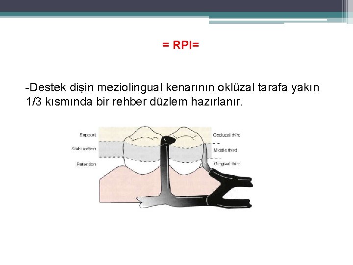 = RPI= -Destek dişin meziolingual kenarının oklüzal tarafa yakın 1/3 kısmında bir rehber düzlem