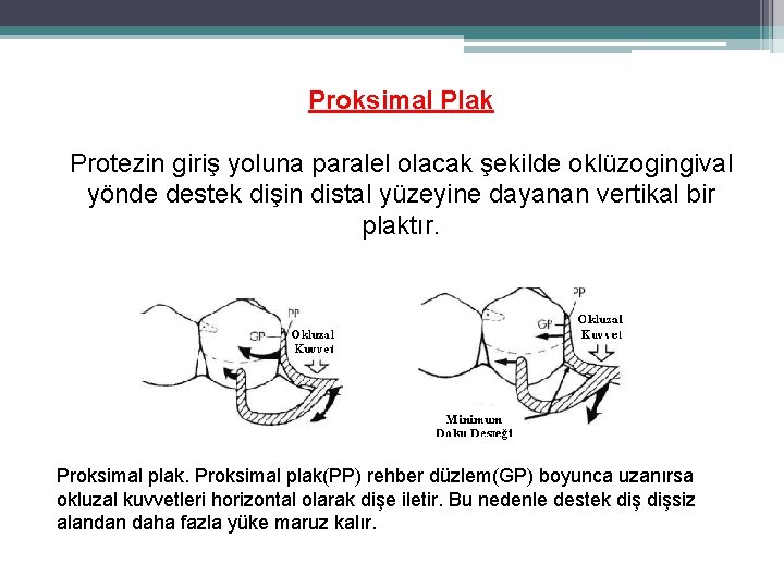 Proksimal Plak Protezin giriş yoluna paralel olacak şekilde oklüzogingival yönde destek dişin distal yüzeyine