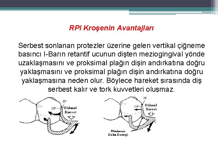 RPI Kroşenin Avantajları Serbest sonlanan protezler üzerine gelen vertikal çiğneme basıncı I-Barın retantif ucunun