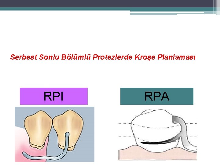 Serbest Sonlu Bölümlü Protezlerde Kroşe Planlaması RPI RPA 